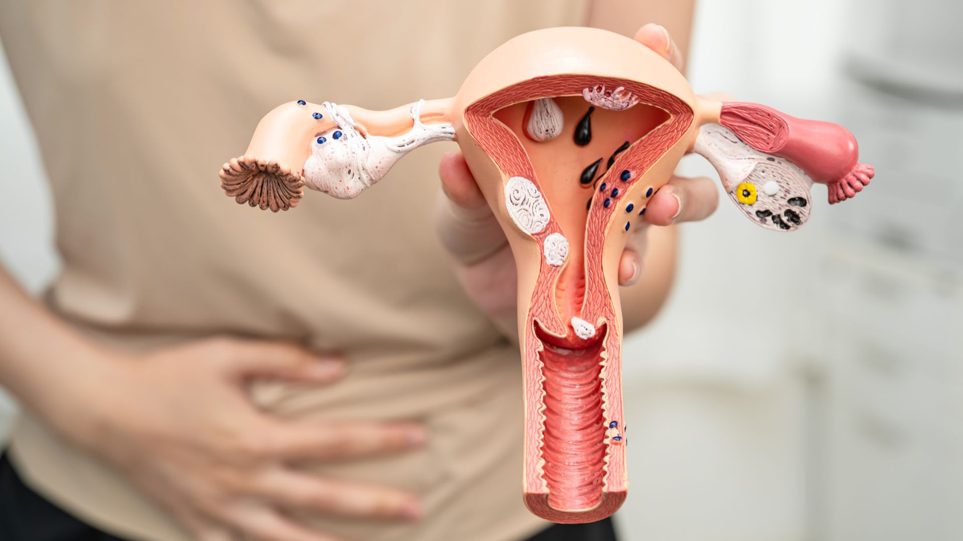Adenomiose uterina: saiba tudo